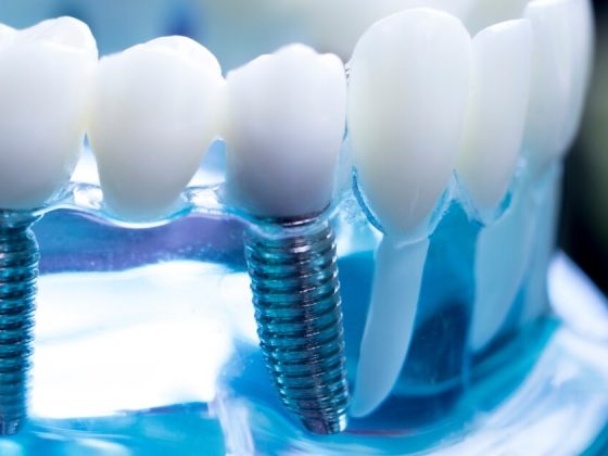 durata impianti dentali