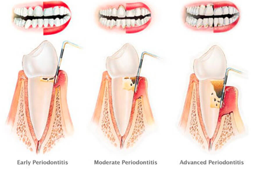 stadi ascesso parodontale