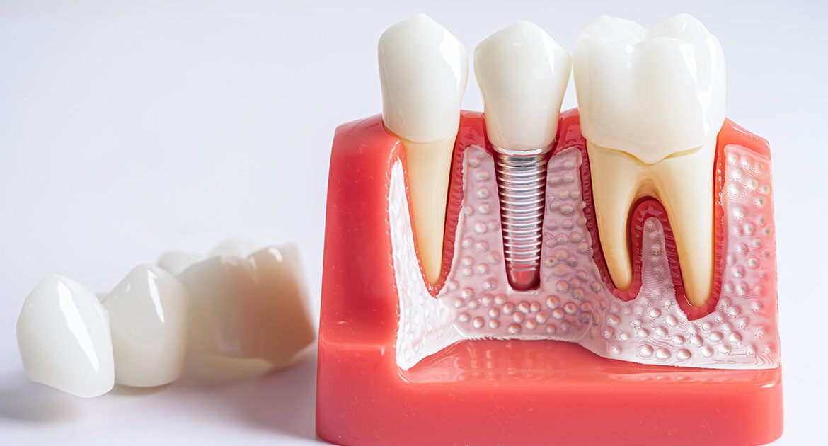 impianto osteointegrato