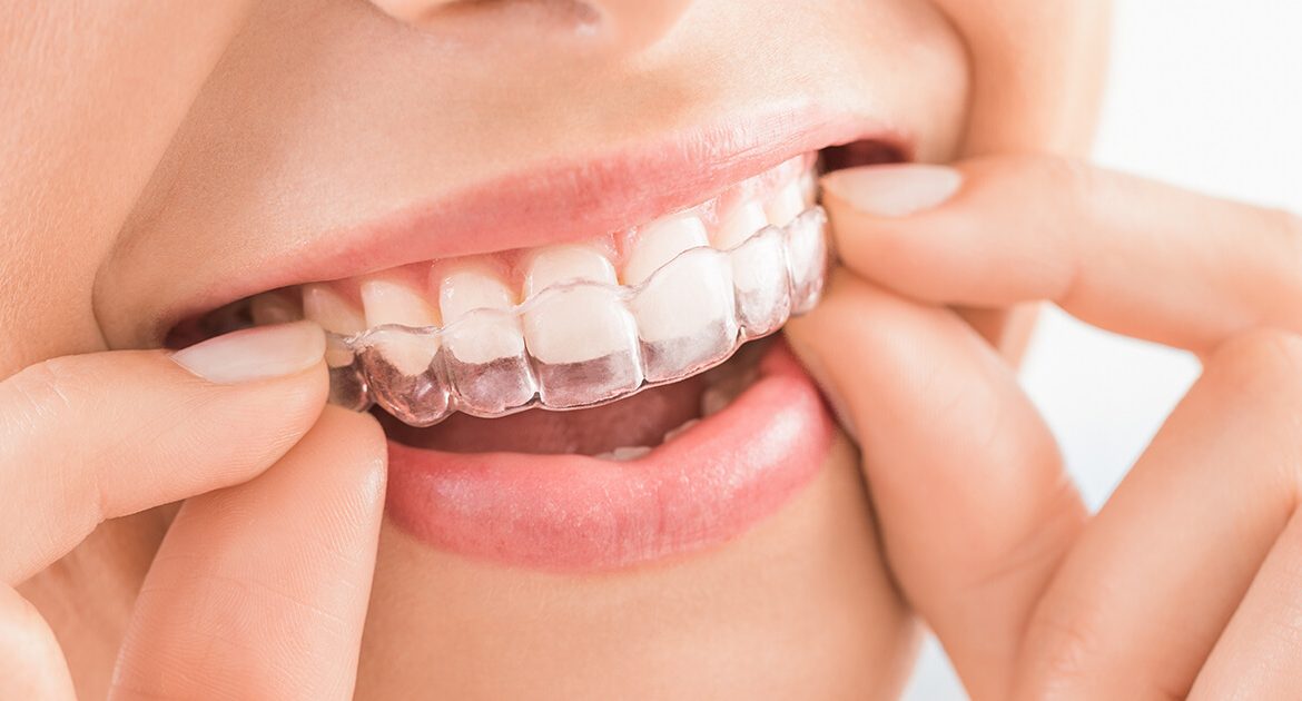 invisalign pro e contro