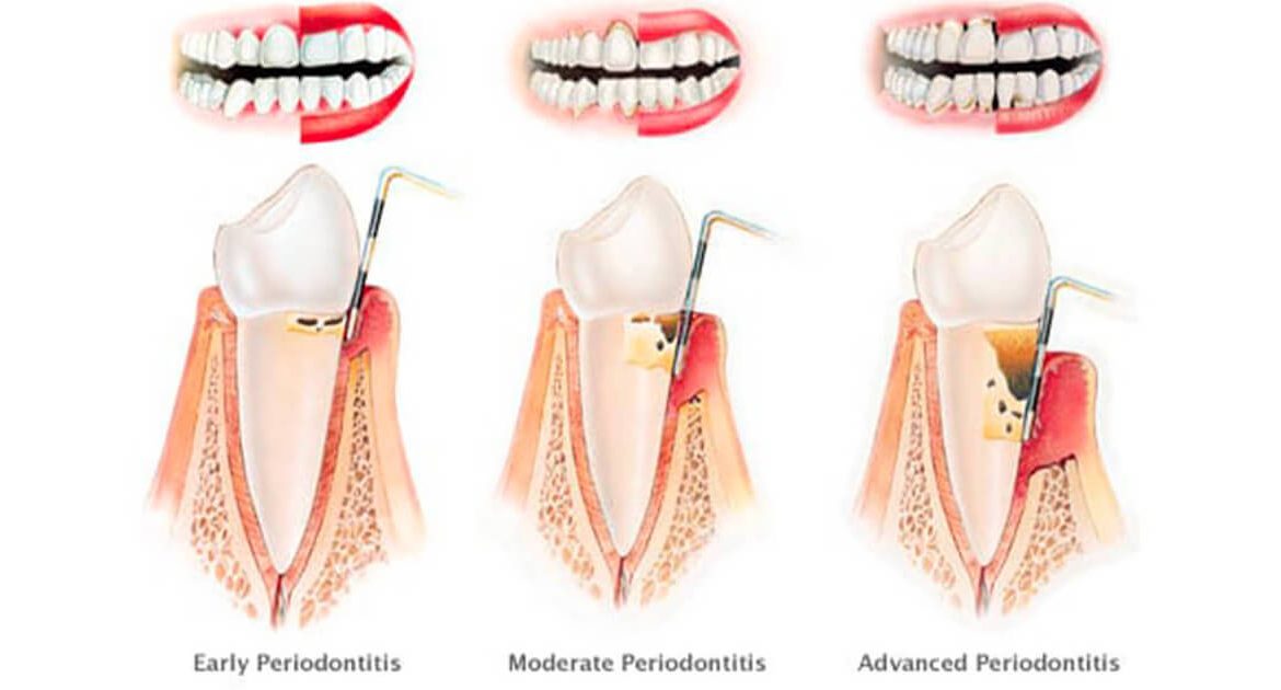 parodontite cos'è