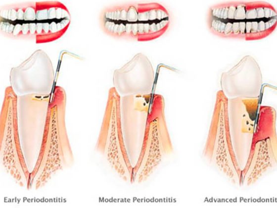 parodontite cos'è
