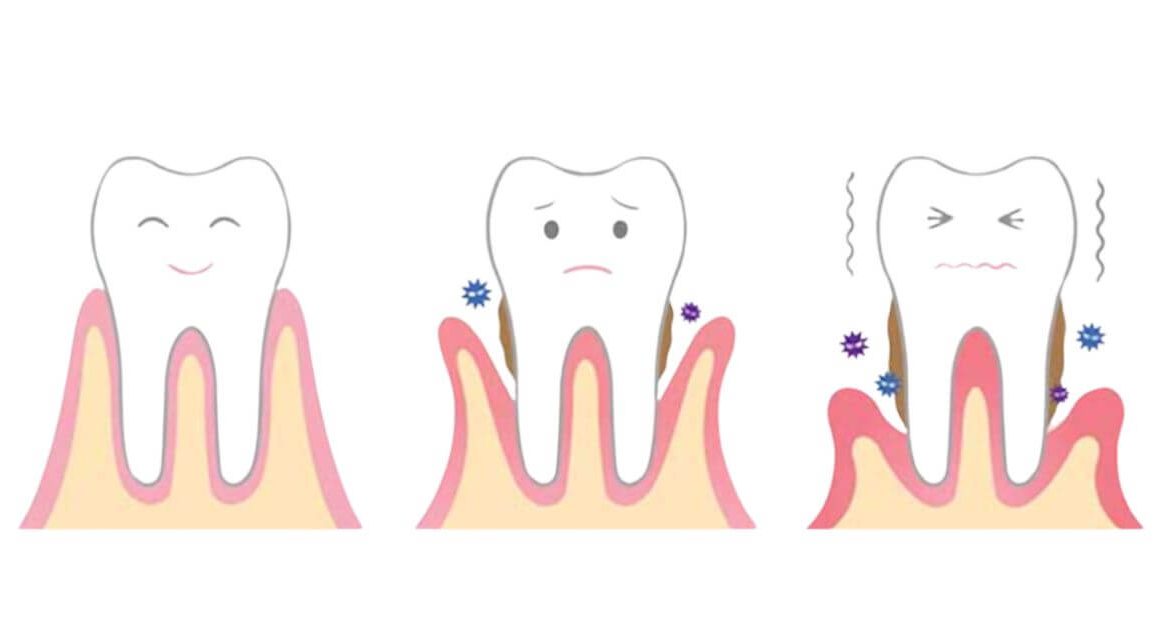 denti che si muovono