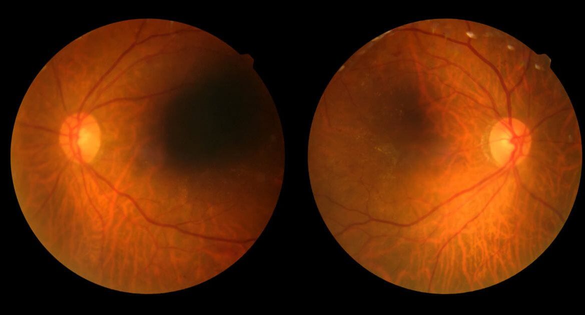 retinopatie sintomi