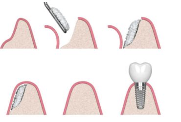 innesto osseo dentale
