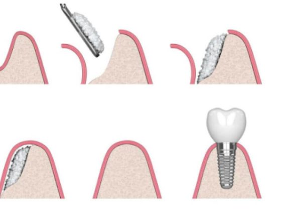 innesto osseo dentale