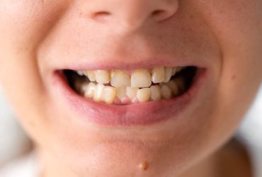 denti storti