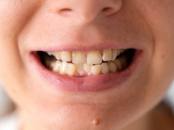 denti storti