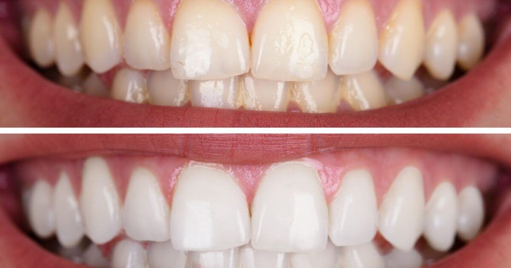 trattamento sbiancamento dentale
