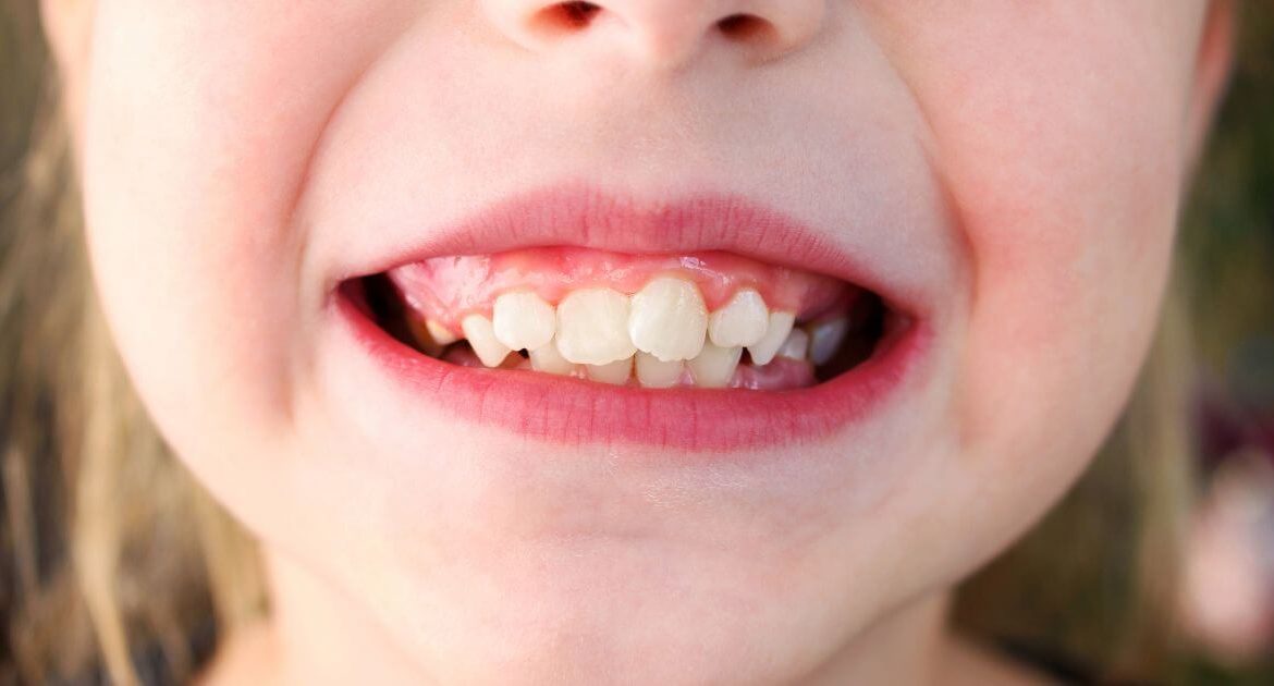 Denti storti bambino: cosa devi fare