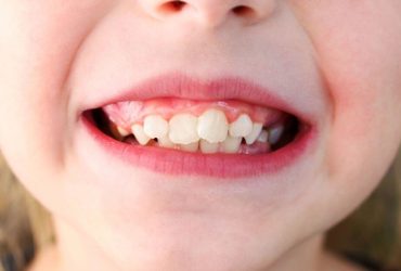 Denti storti bambino: cosa devi fare