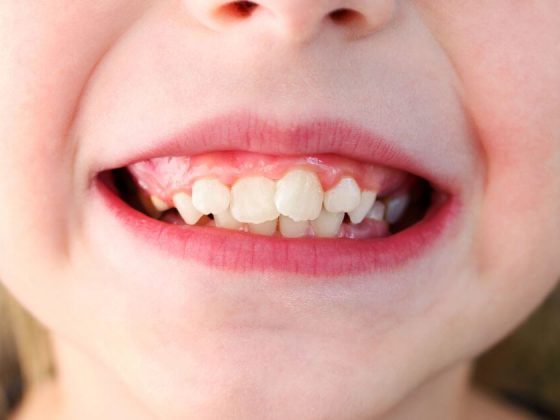 Denti storti bambino: cosa devi fare