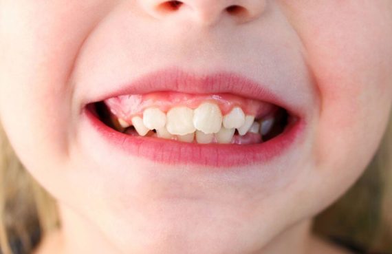 Denti storti bambino: cosa devi fare