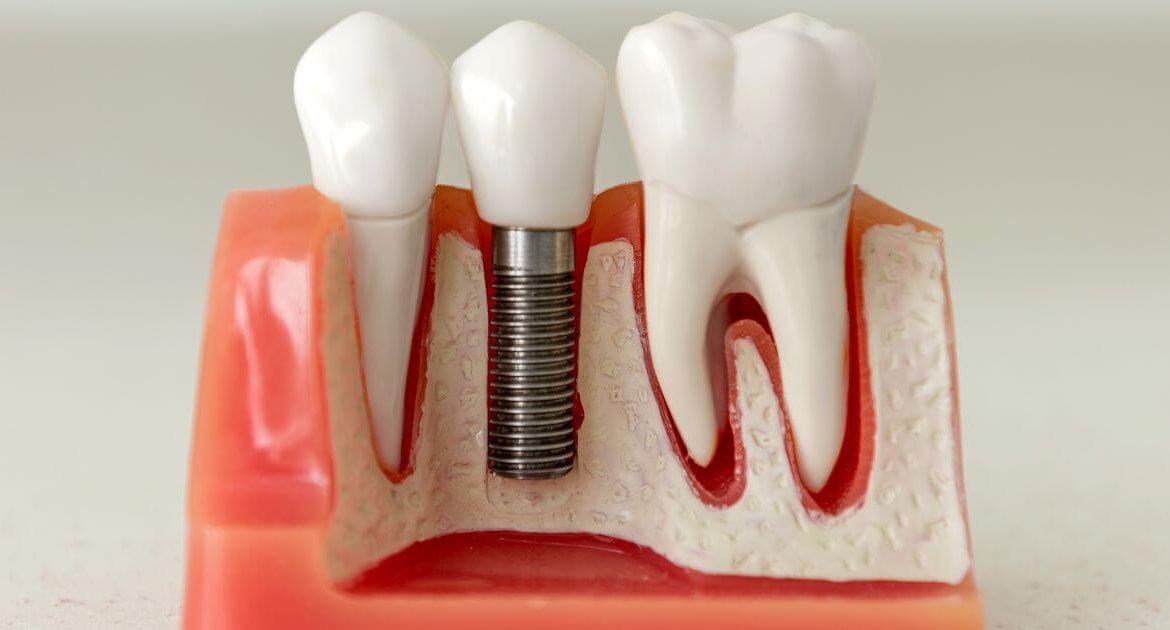 Impianto dentale fallito: cosa fare, sintomi e cause