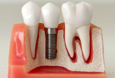 Impianto dentale fallito: cosa fare, sintomi e cause