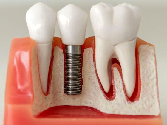 Impianto dentale fallito: cosa fare, sintomi e cause