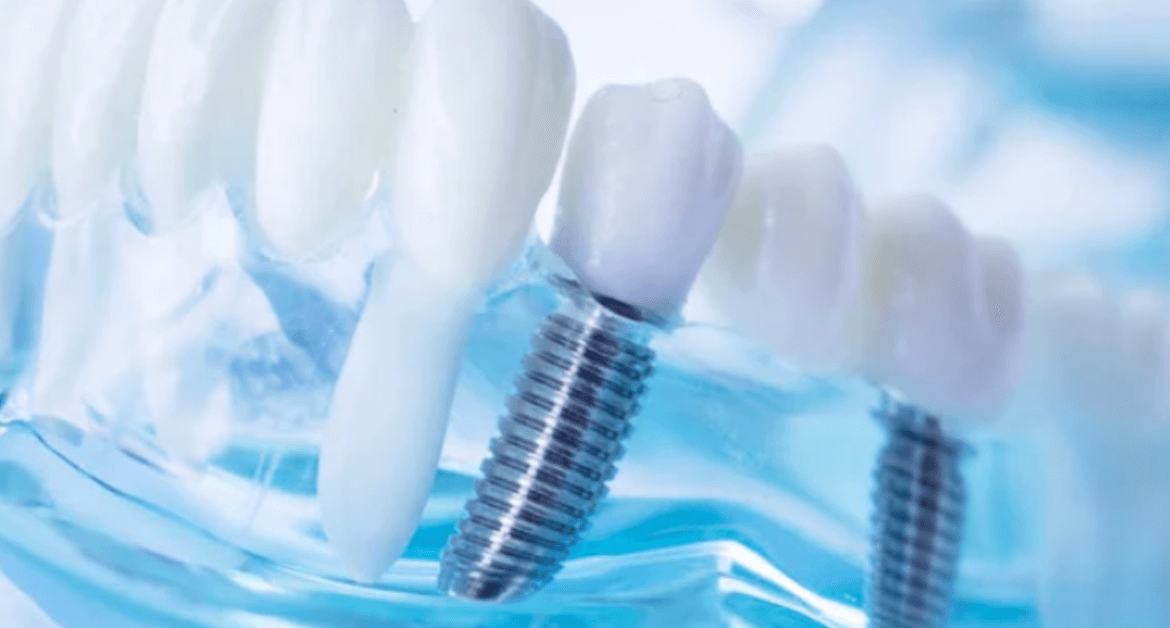 infezione impianto dentale
