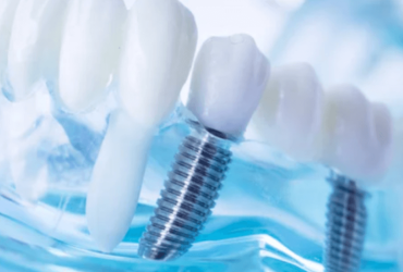 infezione impianto dentale