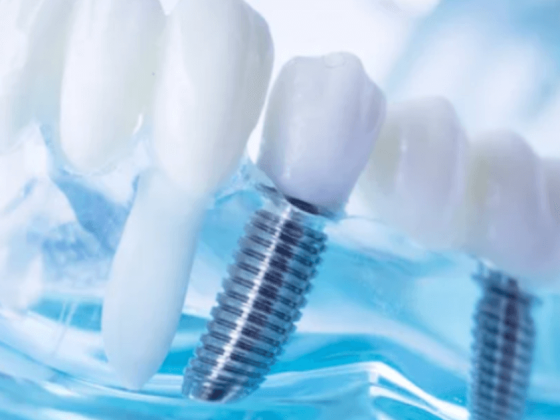 infezione impianto dentale