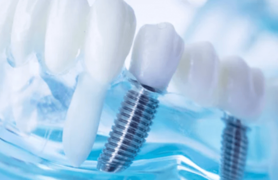 infezione impianto dentale