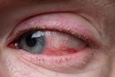 Infiammazione dell'occhio: cause, sintomi e cure