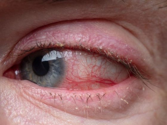 Infiammazione dell'occhio: cause, sintomi e cure