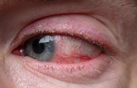Infiammazione dell'occhio: cause, sintomi e cure