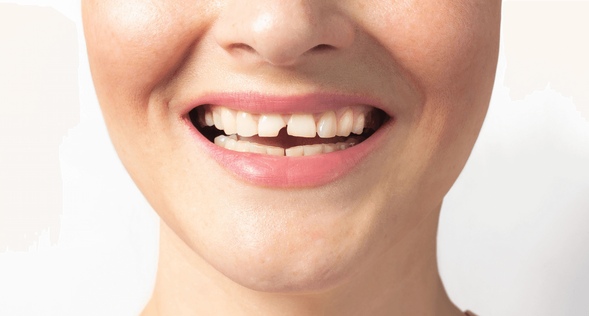 Dente rotto senza dolore: cosa significa e quando preoccuparsi