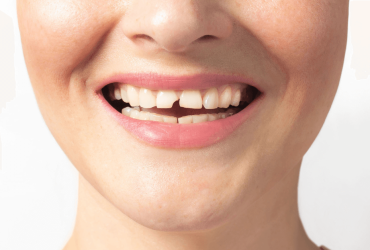 Dente rotto senza dolore: cosa significa e quando preoccuparsi