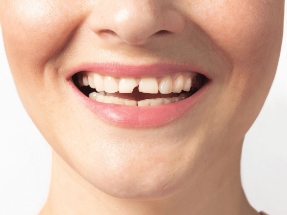 Dente rotto senza dolore: cosa significa e quando preoccuparsi
