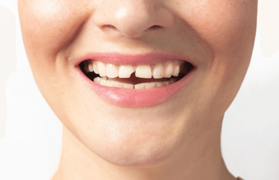 Dente rotto senza dolore: cosa significa e quando preoccuparsi