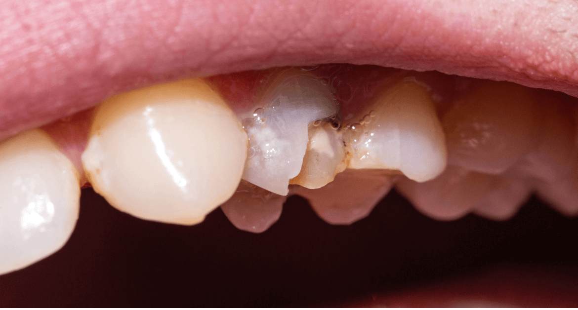 Come intervenire su un dente scheggiato senza compromettere il sorriso