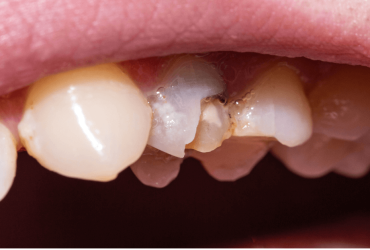 Come intervenire su un dente scheggiato senza compromettere il sorriso