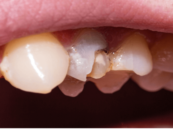 Come intervenire su un dente scheggiato senza compromettere il sorriso