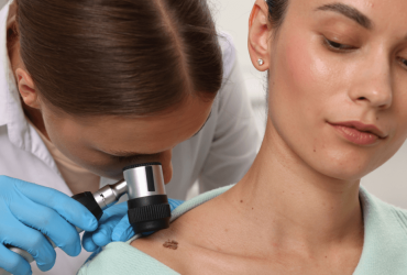 Perché un neo si infiamma? Le cause e i segnali da notare