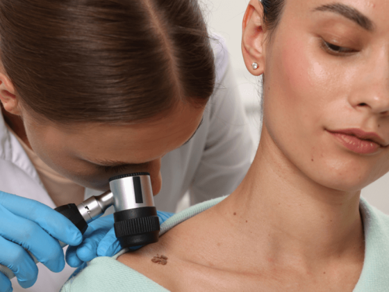 Perché un neo si infiamma? Le cause e i segnali da notare