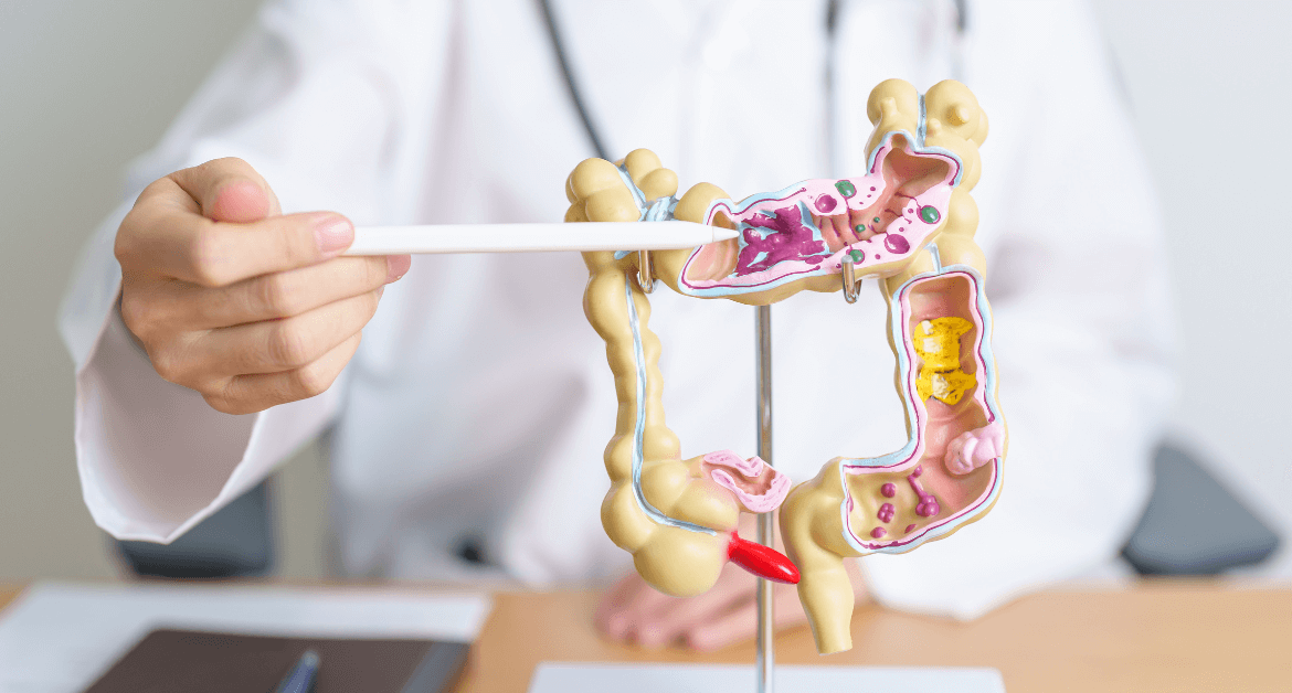 Diverticolite e alimentazione: i cibi da limitare per stare meglio