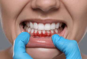 Gengiva gonfia: cause, rimedi e quando rivolgersi al dentista