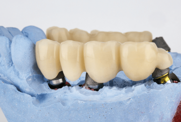 Ponti dentali fissi o mobili: quale scegliere per il tuo sorriso